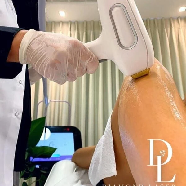 הסרת שיער בלייזר קר